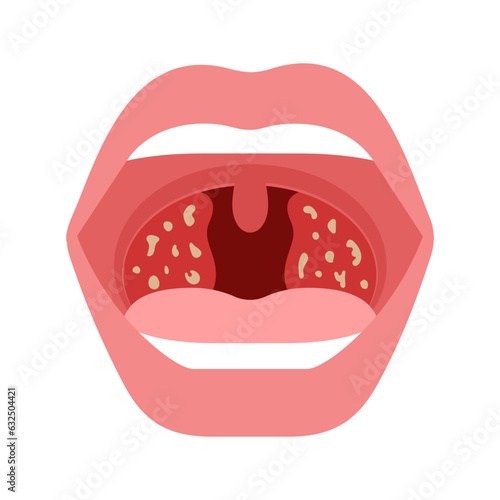 Pain in throat, tonsillitis of human. Open mouth with infection plugs, redness of tonsils. Inflammation airway, pain in throat. Vector