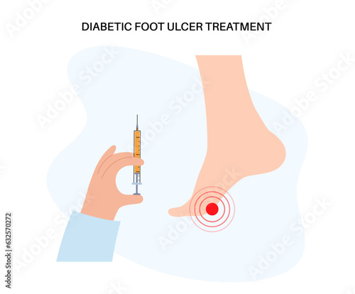 Diabetic Foot Ulcers