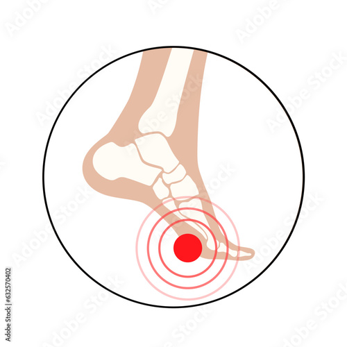 Diabetic Foot Ulcers