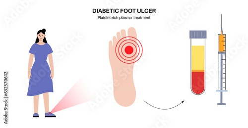 Diabetic Foot Ulcers photo