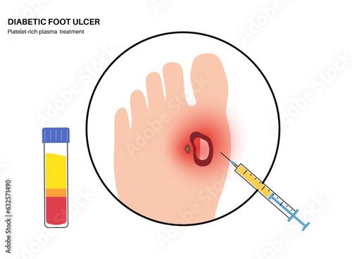 Diabetic Foot Ulcers