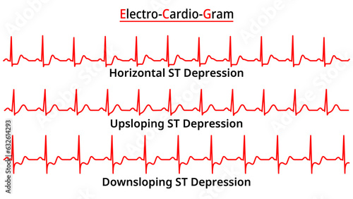 Set of ECG Common Abnormalities - ST Segment Depression - Upsloping - Downsloping - Horizontal - Electrocardiogram Vector Medical Illustration photo