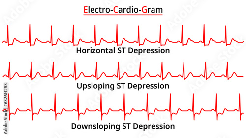 Set of ECG Common Abnormalities - ST Segment Depression - Upsloping - Downsloping - Horizontal - Electrocardiogram Vector Medical Illustration