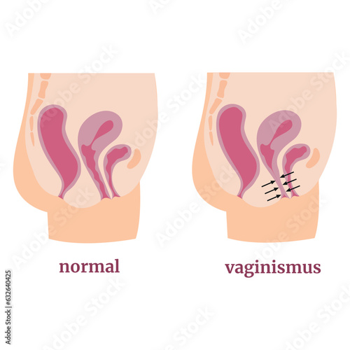 Vaginismus. Spasm of the muscles of the vagina and pelvic floor. Medical infographic, poster, tutorial. Vector illustration