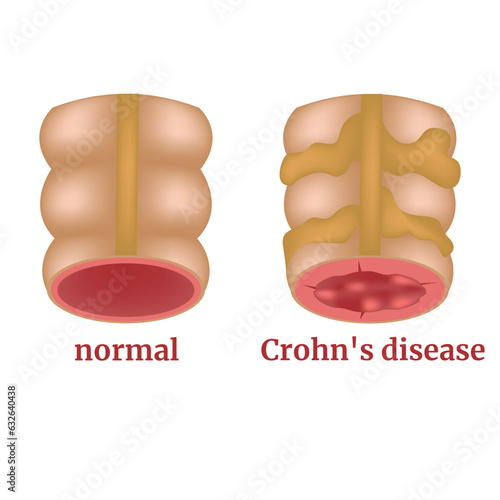 Crohn's disease. Chronic inflammation of the digestive tract. Cobblestone Syndrome. Diagram with diseased intestines. Medical poster. Vector illustration