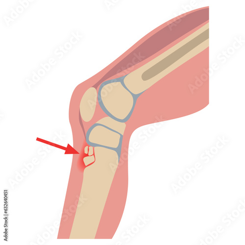 Osgood-Schlatter disease. Destruction of the tibial nucleus. Human leg on the side. Medical poster, infographics. Vector illustration