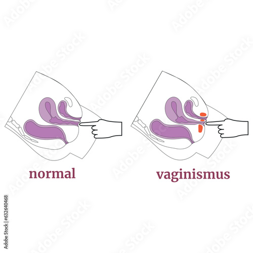 Vaginismus. Spasm of the muscles of the vagina and pelvic floor. Medical infographic, poster, tutorial. Vector illustration photo