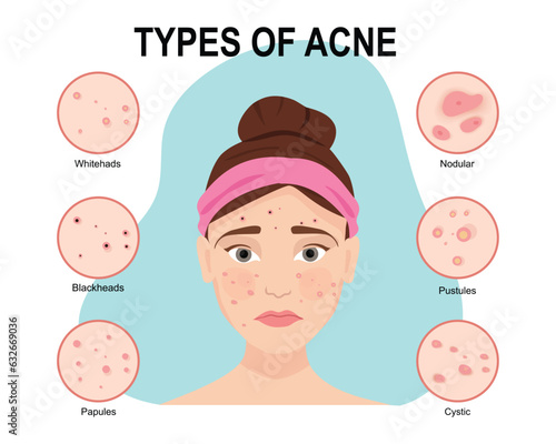 Types of acne. Skin problems