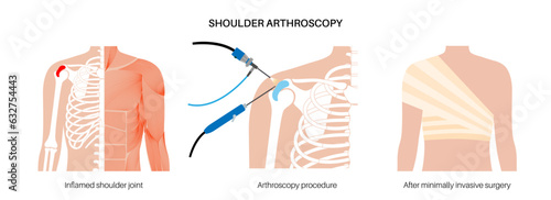 Shoulder arthroscopy poster