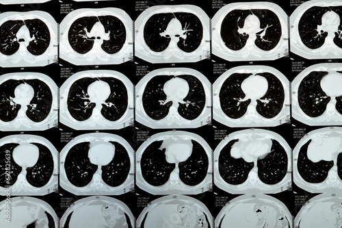 Multi slice CT scan of the chest showing normal study, normal appearance of the lungs, parenchyma, pulmonary vasculature,  mediastinal structures, no adenopathy, no pleural effusion, no abnormality photo