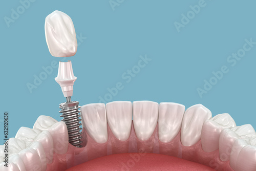 Photos Dental implant and ceramic crown