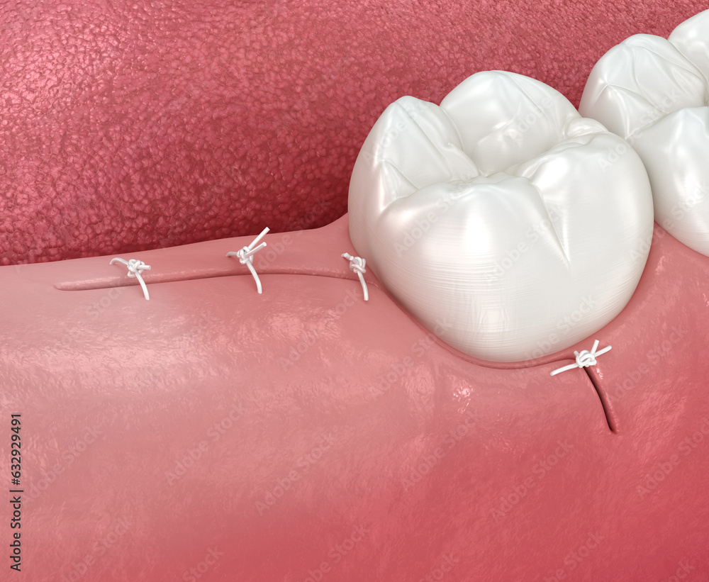 Stitches on gum after wisdom tooth extraction. 3D illustration of