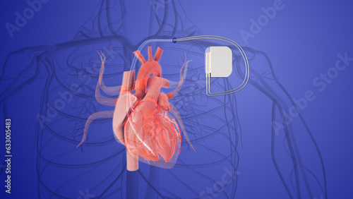Fotografija pacemaker in a human heart implant vein in the heart