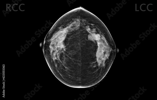  X-ray Digital Mammogram both side CC view . mammography or breast scan for Breast cancer BI-RADS 5; Highly suggestive of malignancy .
