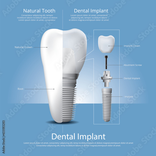 Human Teeth Dental Implant