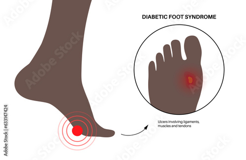 Diabetic Foot Ulcers