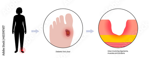 Diabetic Foot Ulcers