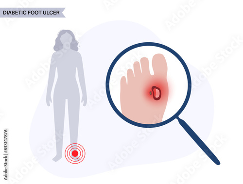 Diabetic Foot Ulcers