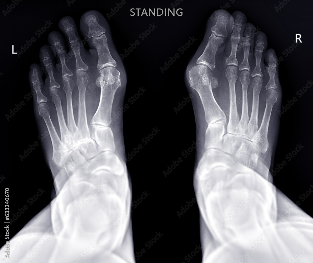Foot x-ray image AP standing view isolated on black background. Foot x-ray image AP standing view isolated on black background.