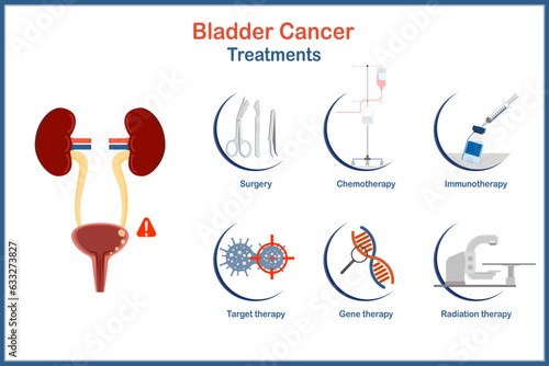 Vector medical illustration in flat style,bladder cancer treatment infographic.Surgery,chemotherapy, immunotherapy,targeted therapy,gene therapy,radiation therapy.infographic of health care concept