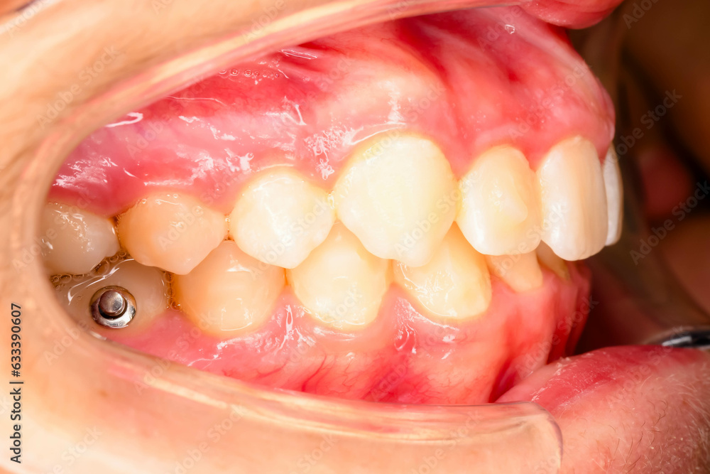 Fototapeta premium Intra oral photography of a maxillary arch in palatal view