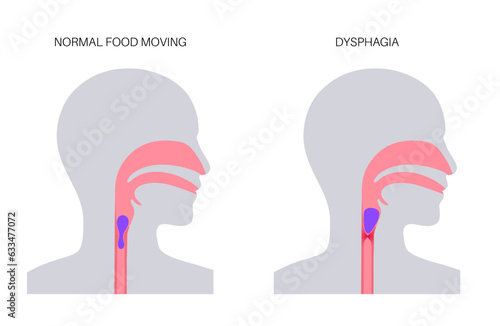 Dysphagia medical poster