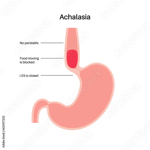 Esophageal achalasia disease
