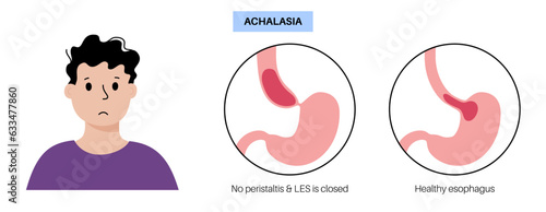 Esophageal achalasia disease