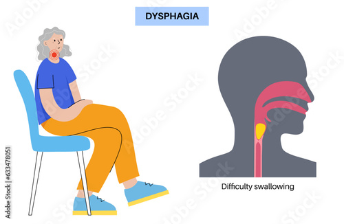 Esophageal achalasia disease photo