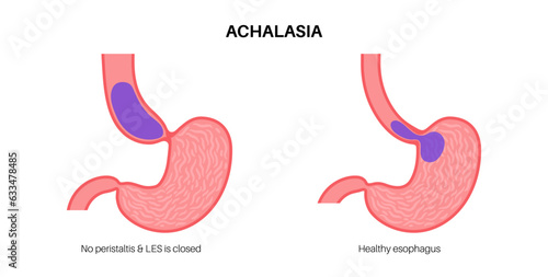 Esophageal achalasia disease photo