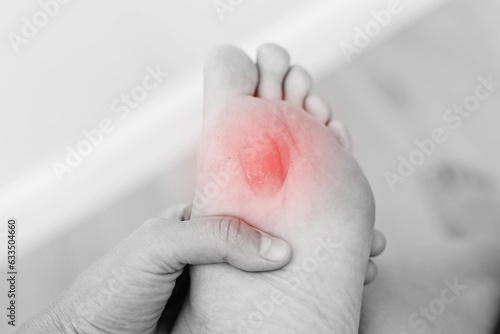 Close up black white photo of woman's foot sole with painful callus with red point. Female is suffering from pain due to corn on leg. The problem is due to tight shoes. Healthcare and medicine concept