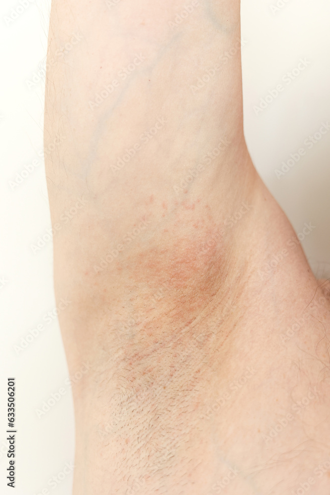 Allergy underarm. Cropped photo of irritation, inflammation on the