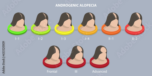 3D Isometric Flat Vector Conceptual Illustration of Androgenic Alopecia, Balding Progress
