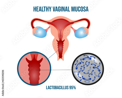 Gynecology healthy vaginal mucosa, lactobacillus infographic 