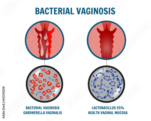Gynecology disease, bacterial vaginosis, medical infographic 