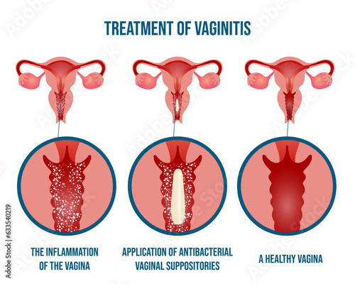 Gynecology disease, bacterial vaginosis, medical infographic, treatments of vaginitis