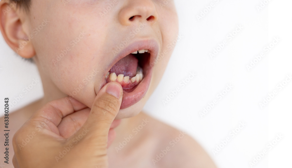 one kid child tooth is falling, permanent raised from back.bloody teeth in front close up one kid child tooth is falling, permanent raised from back.bloody teeth in front close up