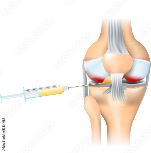 Osteoarthritis treatment. Syringe and Human knee joint