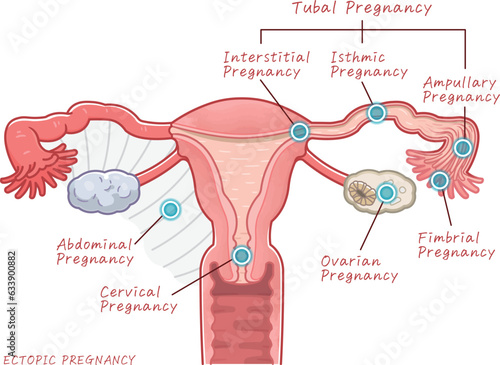 ectopic pregnancy、uterus、ovary、illustration