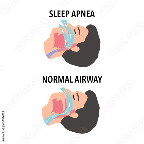 Sleep apnea is a potentially serious sleep disorder in which breathing repeatedly stops and starts. If you snore loudly and feel tired even after a full night's sleep, you might have sleep apnea.
