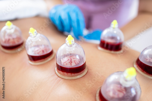 Hijama wet cupping treatment. Close up view on cups filled with blood. Medical treatment and pain relief.