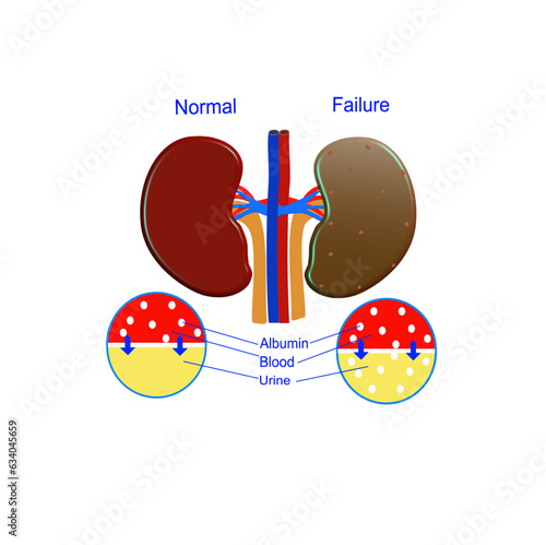 Chronic kidney disease, vector illustration