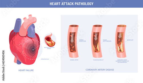 Pathology of a heart attack and atherosclerosis medical illustration