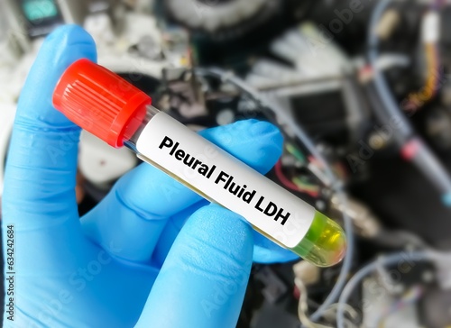Pleural fluid for LDH test. LDH is a marker of inflammation or cellular injury or TB.  lactate dehydrogenase photo