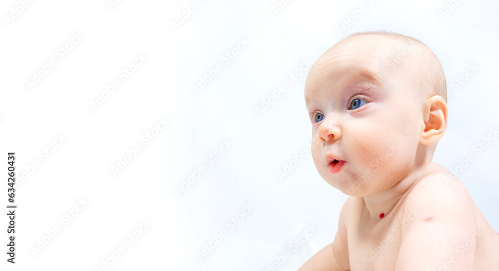 a baby with a hemangioma on his neck lies on a white background. banner with a copy space. profile of a little bald baby girl. the kid looks to the side a baby with a hemangioma on his neck lies on a white background. banner with a copy space. profile of a little bald baby girl. the kid looks to the side