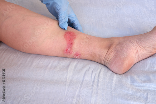 doctor treats large healing wound from on lower leg with scars of adult female patient, redness, scarring of skin, concept of medical care, health care, human tissue regeneration, scald on women feet