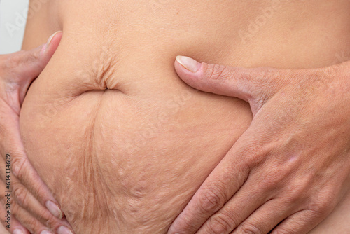 Fotografiet Cropped woman hands on belly pressed skin to show sagging skin after diet and st