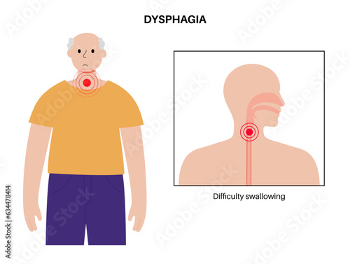 Esophageal achalasia disease