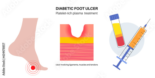 Diabetic Foot Ulcers