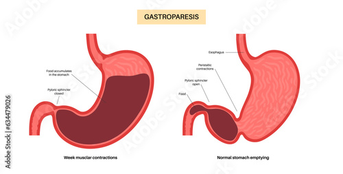 Gastroparesis anatomical poster